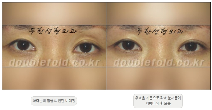 [두한성형외과 쌍커플재수술] - [비대칭 쌍커풀 라인] 관련 이미지 22