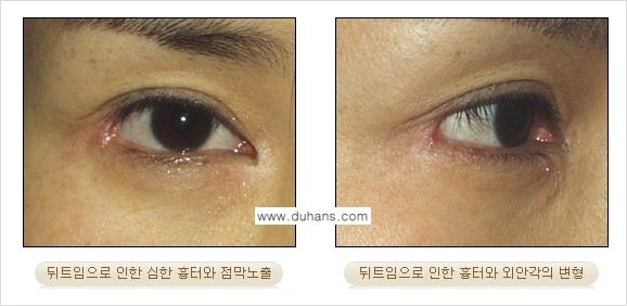 [두한성형외과 NO.1 눈성형] - [뒤트임 수술에 대한 정보] 관련 이미지 11