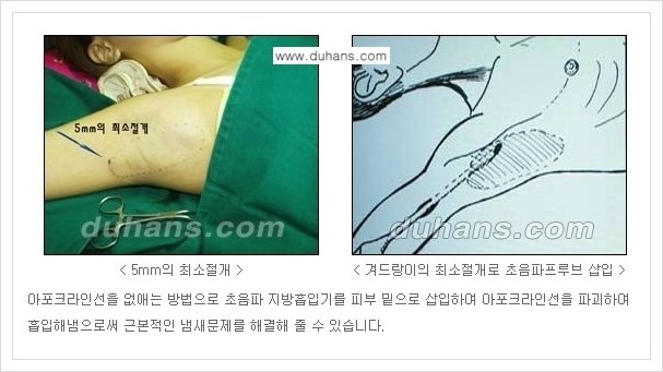 [두한성형외과 성형 FOCUS 지방흡입] - [액취증 - 다한증 초음파 컷터 지방흡입 ①] 관련 이미지 9