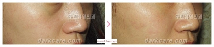 [두한성형외과 경쟁력 멀티성형] - [다크써클 + 인디언밴드 콤비 프로그램 안내] 관련 이미지 14