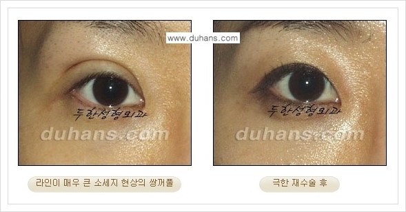 [두한성형외과 경쟁력 망가진 눈 복원수술] - [두꺼운 라인을 교정하는 극한 재수술(Extreme Reoperation) 안내] 관련 이미지 9