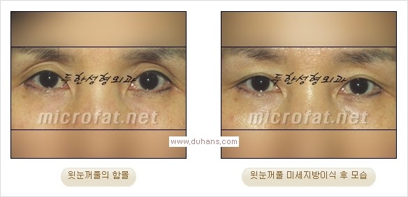 [두한성형외과 경쟁력 쌍꺼풀 재수술, 극한 눈재수술] - [어색한 쌍꺼풀 라인을 교정하는 윗눈꺼풀 미세지방이식] 관련 이미지 24