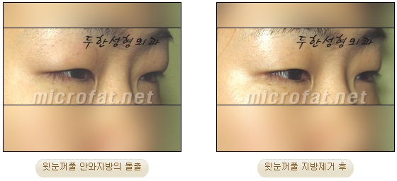 [두한성형외과 지방제거] - [눈밑지방제거, 윗눈꺼풀지방제거] 관련 이미지 60