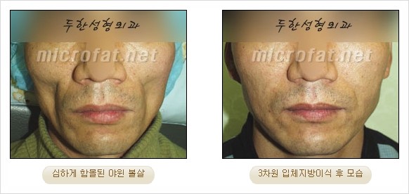 [두한성형외과 경쟁력 지방이식 리더] - [Col-fat(콜펫)지방이식, 3차원 입체지방이식, 2차원 평면지방이식] 관련 이미지 49
