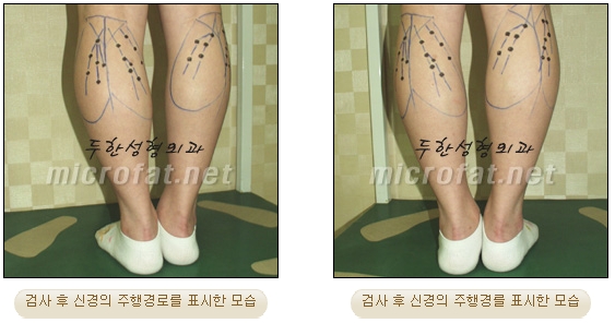 [Duhan Plastic Surgery Clinic Calf Contouring] - [Calf Reduction] image 8