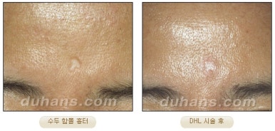 Duhan Plastic Surgery Scar Treatment - Improvement of Chickenpox Scars, Acne Scars, and Depressed Scars image 9