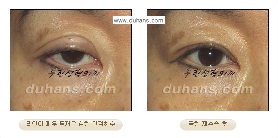 [두한성형외과 경쟁력 눈성형] - [두꺼운 라인을 교정하는 극한 눈 재수술 2.] 관련 이미지 9