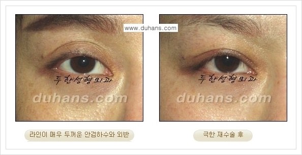 [두한성형외과 경쟁력 망가진 눈 복원수술] - [두꺼운 라인을 교정하는 극한 재수술(Extreme Reoperation) 안내] 관련 이미지 15