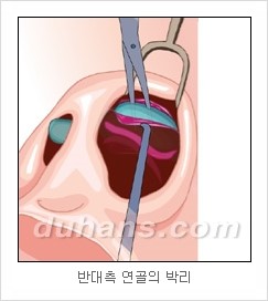 DuHan Plastic Surgery Revision Rhinoplasty - AlloDerm Nose Surgery, SureDerm Nose Surgery image 8