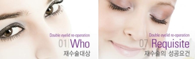 [Ptosis, Duhan Plastic Surgery] - [Sleepy-Looking Eyes, Ptosis Eye Correction] image 23