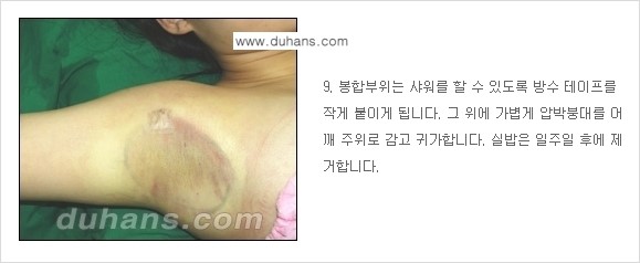 [두한성형외과 성형 FOCUS 지방흡입] - [액취증 - 다한증 초음파 컷터 지방흡입 ④] 관련 이미지 10