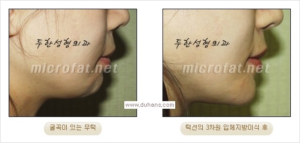 ⁠⁠[두한성형외과 경쟁력 미세지방이식] - [턱 미세지방이식 - 안면윤곽 교정 안내] 관련 이미지 17