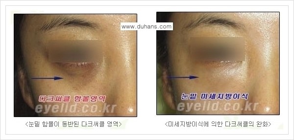 [두한성형외과 경쟁력 눈밑성형] - [다크써클 수술 안내 2.] 관련 이미지 3