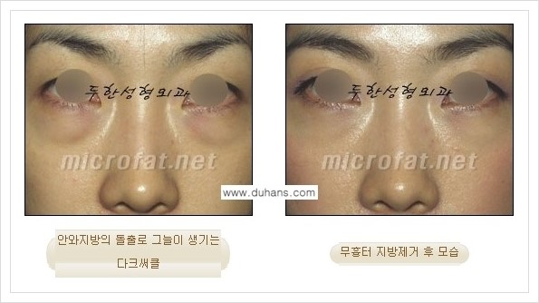 [두한성형외과 경쟁력 눈밑성형] - [눈밑지방제거, 눈위지방제거 안내 1.] 관련 이미지 15