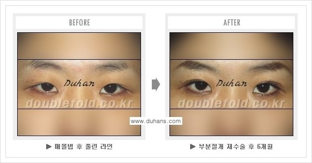 [두한성형외과] - [쌍꺼풀 재수술 푸는 수술을 하고 내원했을 경우의 문제] 관련 이미지 6