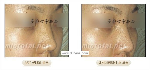 [두한성형외과 경쟁력 코성형] - [미세지방이식을 이용한 자연스러운 코성형 안내] 관련 이미지 19
