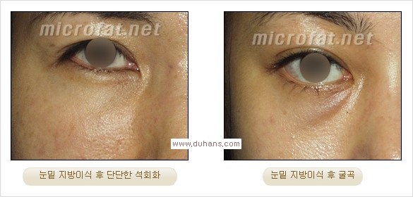 [두한성형외과 경쟁력 미세지방이식] - [미세지방이식, 자가지방이식, 지방이식, 지방주입에 대한 잘못된 정보] 관련 이미지 20
