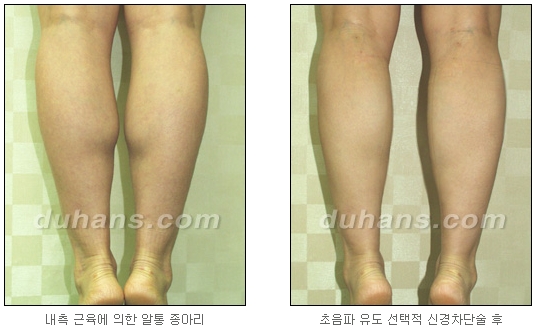 [Duhan Plastic Surgery Calf Reduction] - [How to Get Rid of Calf Muscle Bulges] image 19