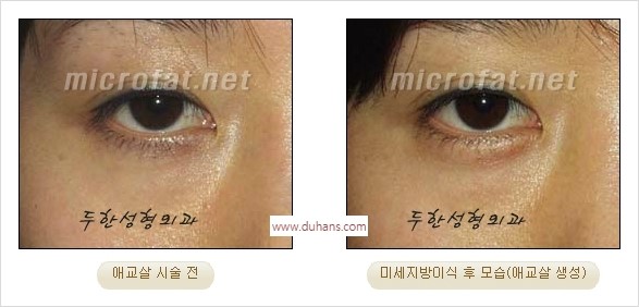 [두한성형외과 경쟁력 미세지방이식] - [애교살 필러 시술의 부작용 교정] 관련 이미지 17