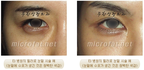 [Duhan Plastic Surgery Wrinkle Improvement] - [Wrinkle Filler Procedure] image 14