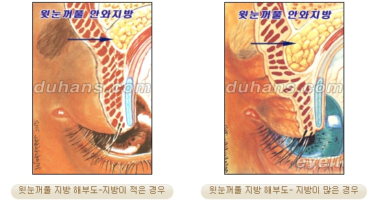 두한성형외과 지방제거 - 눈밑지방, 눈꺼풀지방제거 관련 이미지 2