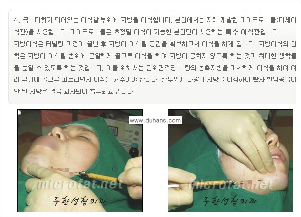 [두한성형외과의 경쟁력 미세지방이식] - [무턱교정 - 턱 미세지방이식 안내 1.] 관련 이미지 12