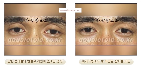 [두한성형외과 경쟁력 눈성형] - [풀려버린 쌍꺼풀 교정 방법] 관련 이미지 13