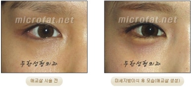 두한성형외과 눈밑성형 - 애교필러 후 눈밑재수술 관련 이미지 54