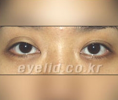 Duhan Plastic Surgery Eye Surgery - Are You a Candidate for Double Eyelid Revision Surgery?! image 8