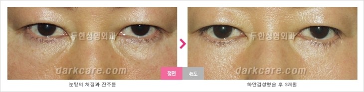 두한성형외과 눈밑수술 - 다크서클 수술 전후 관리 안내 관련 이미지 88
