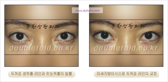 [두한성형외과 경쟁력 눈성형] - [쌍꺼풀 재수술 과정과 쌍꺼풀 재수술 실패의 원인, 쌍꺼풀 재수술의 성공 요건] 관련 이미지 31