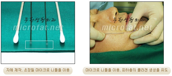 Fat Grafting Leader Duhan Plastic Surgery - Everything About Fat Grafting image 4