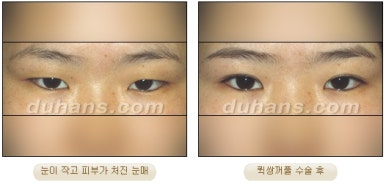 [두한성형외과 쌍커풀수술] - [매력적인 쌍커풀] 관련 이미지 22