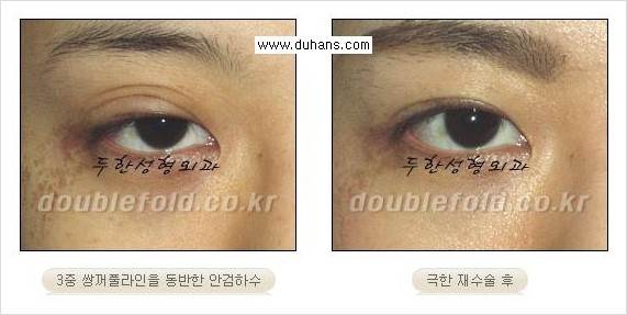 [두한성형외과 경쟁력 쌍꺼풀 재수술, 극한 재수술] - [재수술에서 극복해야 할 극한의 상황과 문제들 안내] 관련 이미지 16