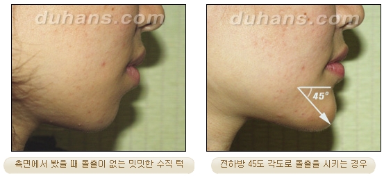 [Duhan Plastic Surgery Micro Fat Grafting] - [Receded Chin, Small Chin, Cleft Chin, Chin Line Asymmetry Correction] image 4