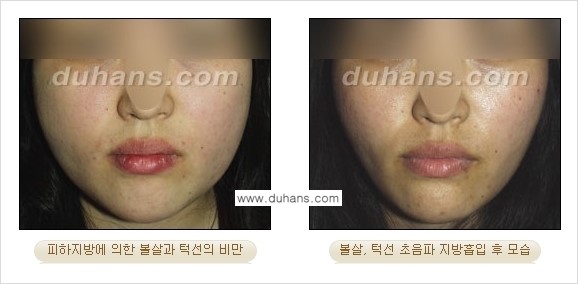 ​​​﻿[두한성형외과 경쟁력 간편지방흡입] - [볼살지방흡입, 턱선지방흡입 시술 과정의 안내] 관련 이미지 10