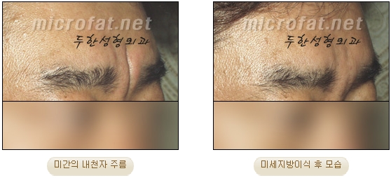 [두한성형외과 자가지방이식] - [미간주름] 관련 이미지 22