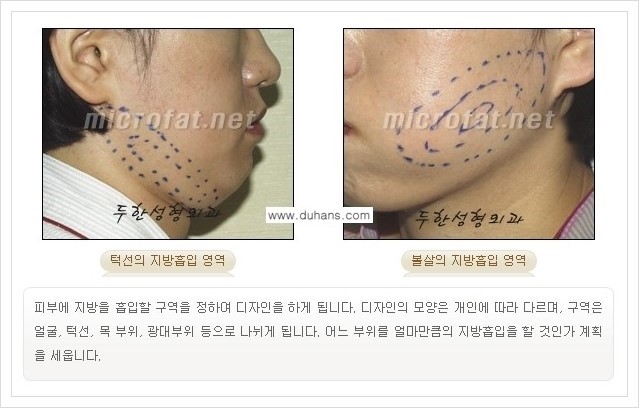 [두한성형외과 경쟁력 얼굴지방흡입] - [통통한 볼살, 두툼한 턱살(턱선)의 지방흡입] 관련 이미지 7