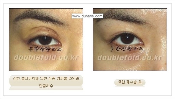 [두한성형외과 경쟁력 쌍꺼풀 재수술] - [극한의 상태에서 쌍꺼풀 재수술 안내 ①] 관련 이미지 8