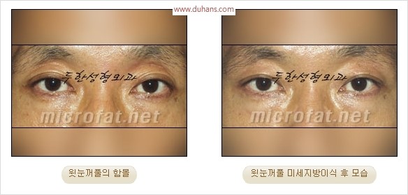 [두한성형외과 경쟁력 눈성형 리더] - [윗눈꺼풀 함몰( #꺼진눈꺼풀) 미세지방이식과 상안검성형]#꺼진눈성형 , #눈위함몰 관련 이미지 18