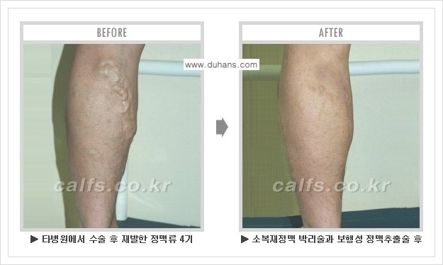 [두한성형외과 경쟁력 멀티종아리성형] - [하지정맥류 치료 안내] 관련 이미지 4