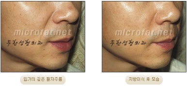 [Duhan Plastic Surgery Face Fat Grafting] - [Reducing Mouth Corners Wrinkles and Nasolabial Folds] image 14