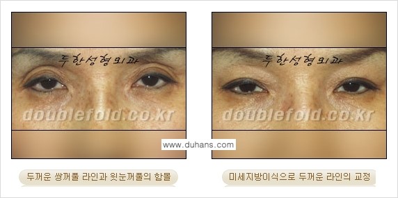 [두한성형외과 NO.1 눈성형] - [함몰된(꺼진) 눈꺼풀에서 쌍꺼풀 라인 교정 2.] 관련 이미지 9