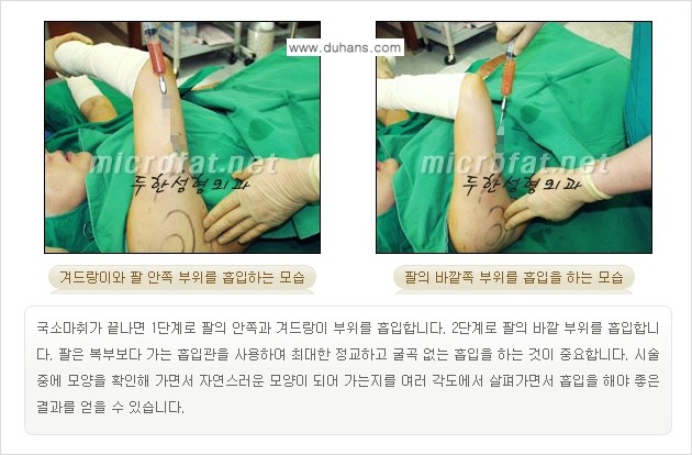 [두한성형외과 겨울엔 지방흡입 도전] - [간편한 복부지방흡입 1.] 관련 이미지 10