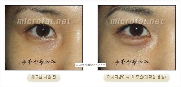 [두한성형외과 경쟁력 눈밑성형] - [눈밑 애교살 시술을 위한 미세지방이식] 관련 이미지 7