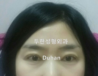 [두한성형외과 쌍커풀재수술] - [심한 소세지눈, 두줄따기, 쌍꺼풀 흉터] 관련 이미지 3