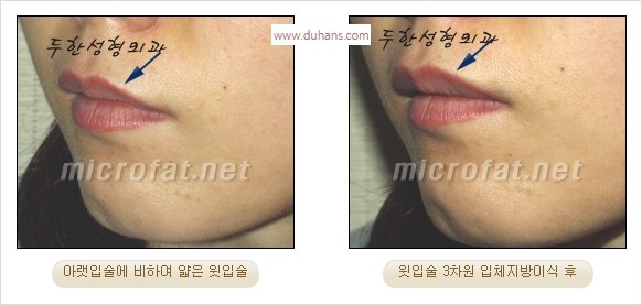 ​​[두한성형외과 경쟁력 미세지방이식] - [볼륨감 있는 입술성형] 관련 이미지 12