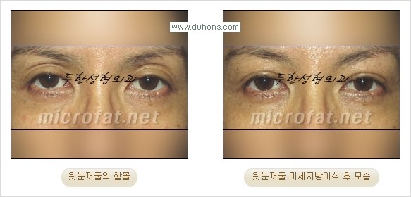 [두한성형외과 경쟁력 미세 #지방이식 ] - [윗 #눈꺼풀함몰, #꺼진눈꺼풀, #눈위지방이식, #눈위함몰] 관련 이미지 25