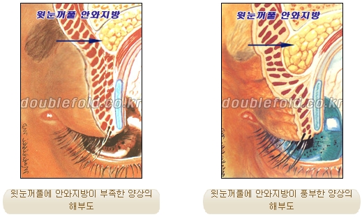 [두한성형외과 쌍커플재수술] - [함몰된 눈꺼풀의 쌍꺼풀 라인 교정] 관련 이미지 4