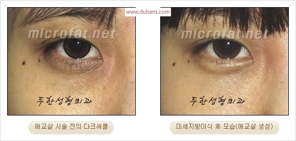 ​﻿[두한성형외과 경쟁력 지방이식] - [눈밑 애교살 시술을 위한 미세지방이식] 관련 이미지 20